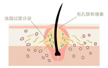 青春期臉上長白色的小痘痘怎么辦？米迪豆專業(yè)祛痘值得信賴！