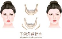 聯(lián)合麗格第 一醫(yī)院何照華院長：想做下頜角手術(shù)，該選哪種術(shù)式？
