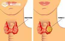 烯旺石墨烯醫(yī)療新發(fā)現(xiàn)：用于探索甲狀腺結(jié)節(jié)治療新方法效果顯著